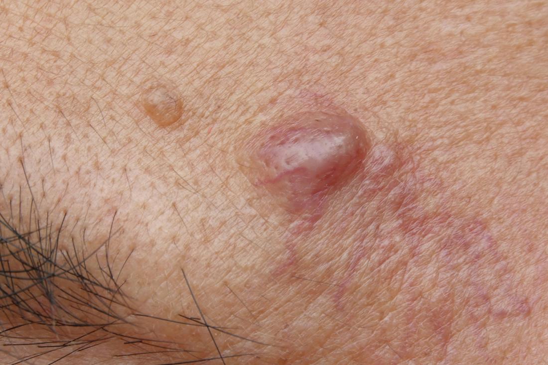 pus in a cyst