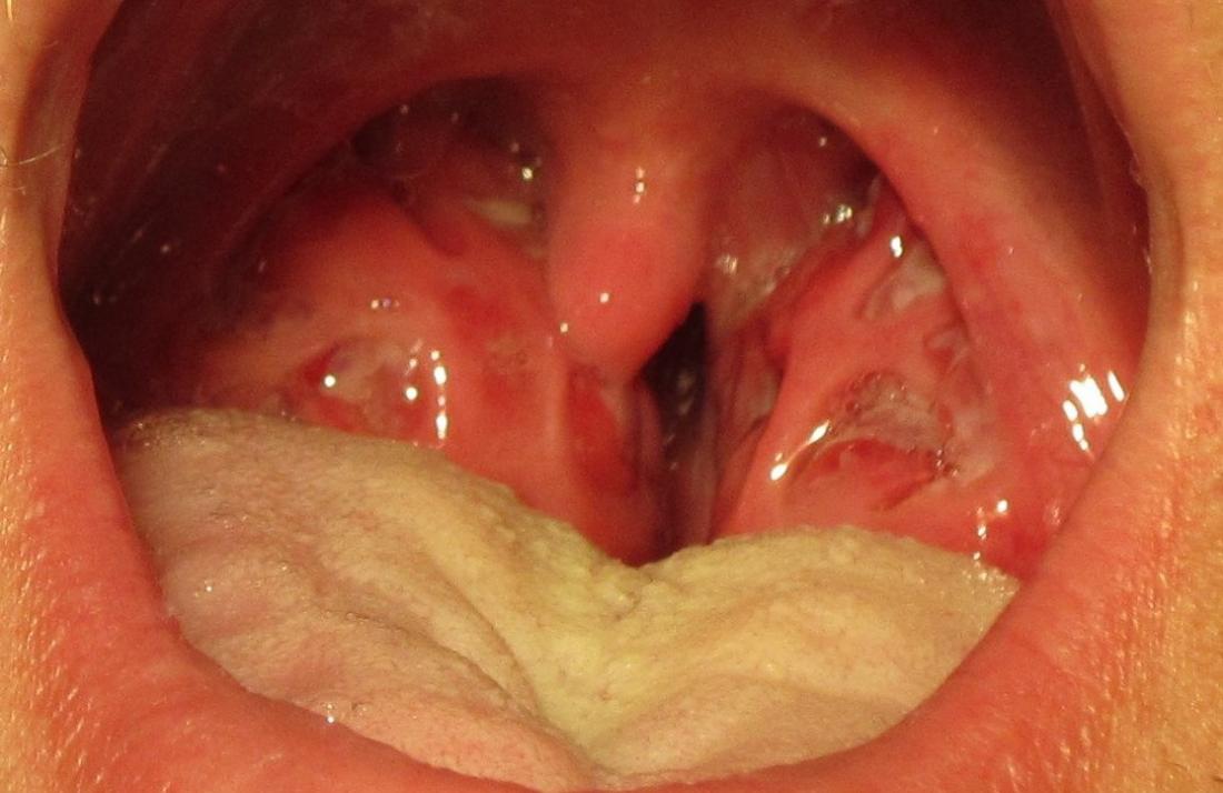 strep throat tonsils