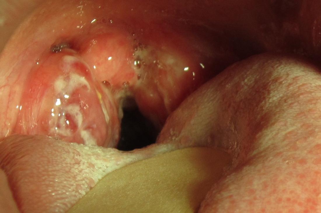 adult mouth spots throat White roof
