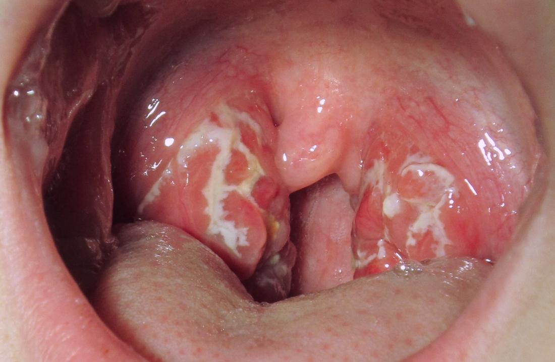 Disappear white will when the throat patches strep from White Spots