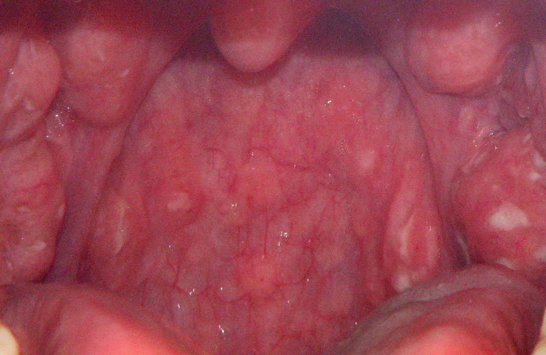 strep throat blisters