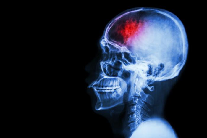 x-ray of brain after stroke