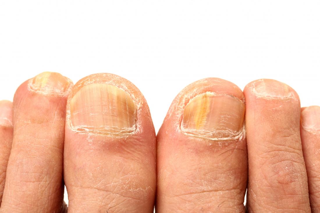 Ingrown Toenail Surgery - Foot & Ankle Experts Health Clinic