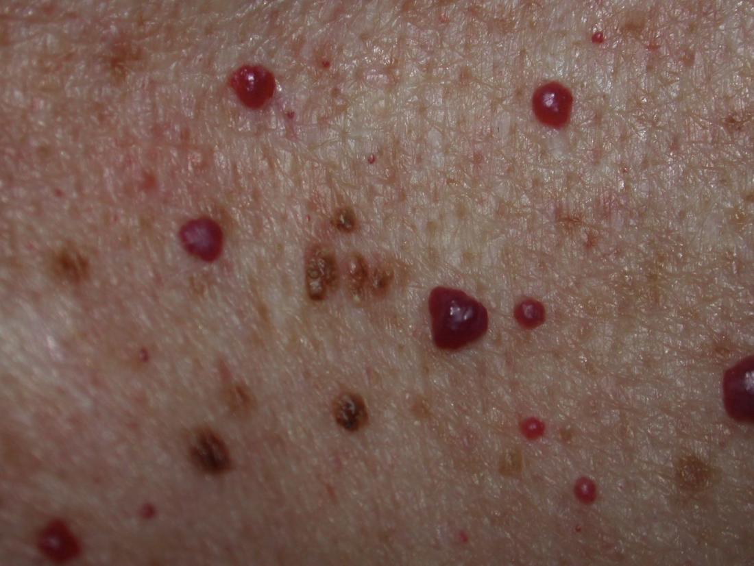 Blood spots outlet on skin