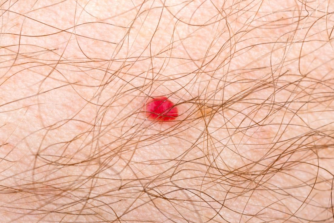 Cherry Angioma Symptoms Causes And Treatment