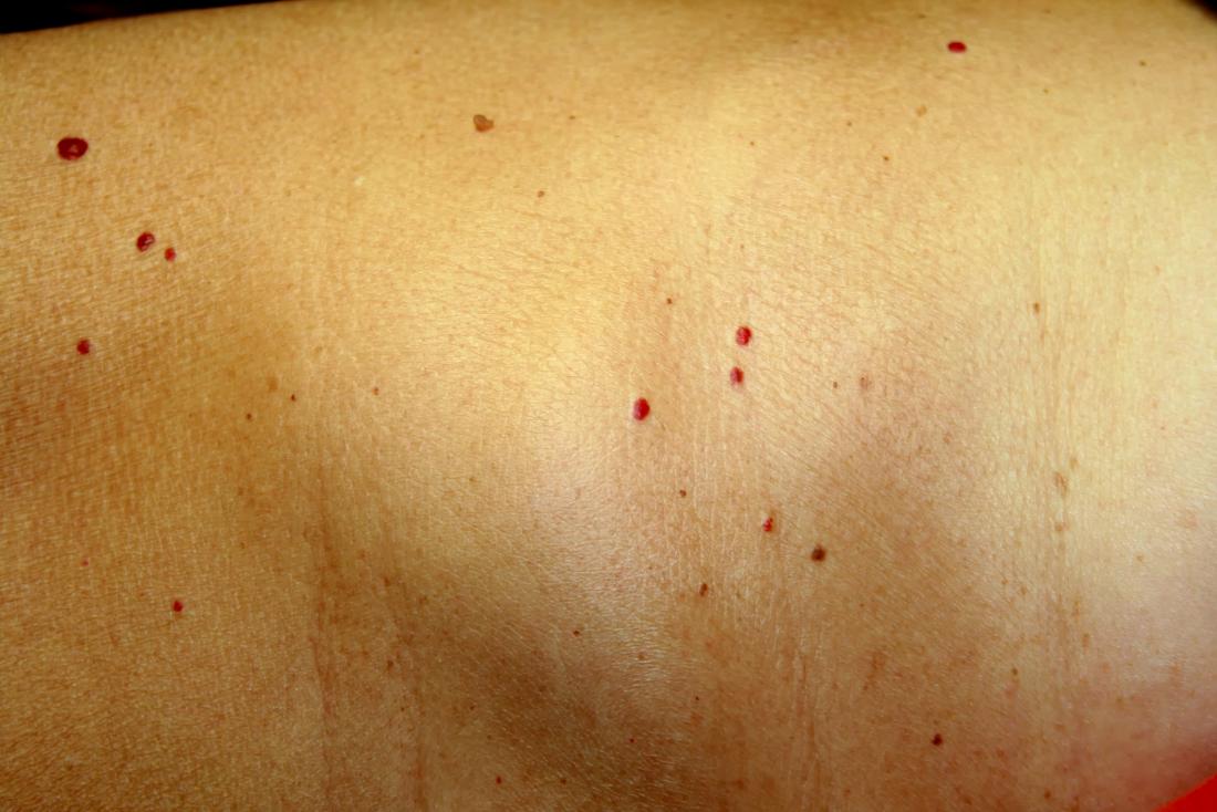 Cherry Angioma Symptoms Causes And Treatment 