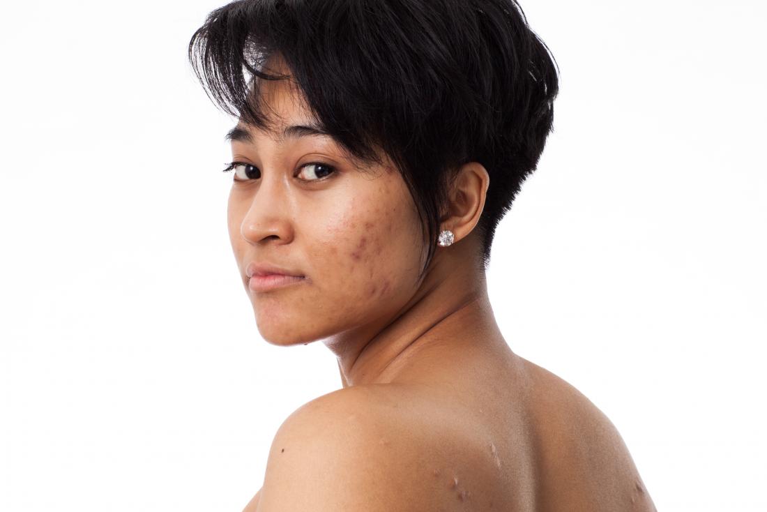 menstruation acne