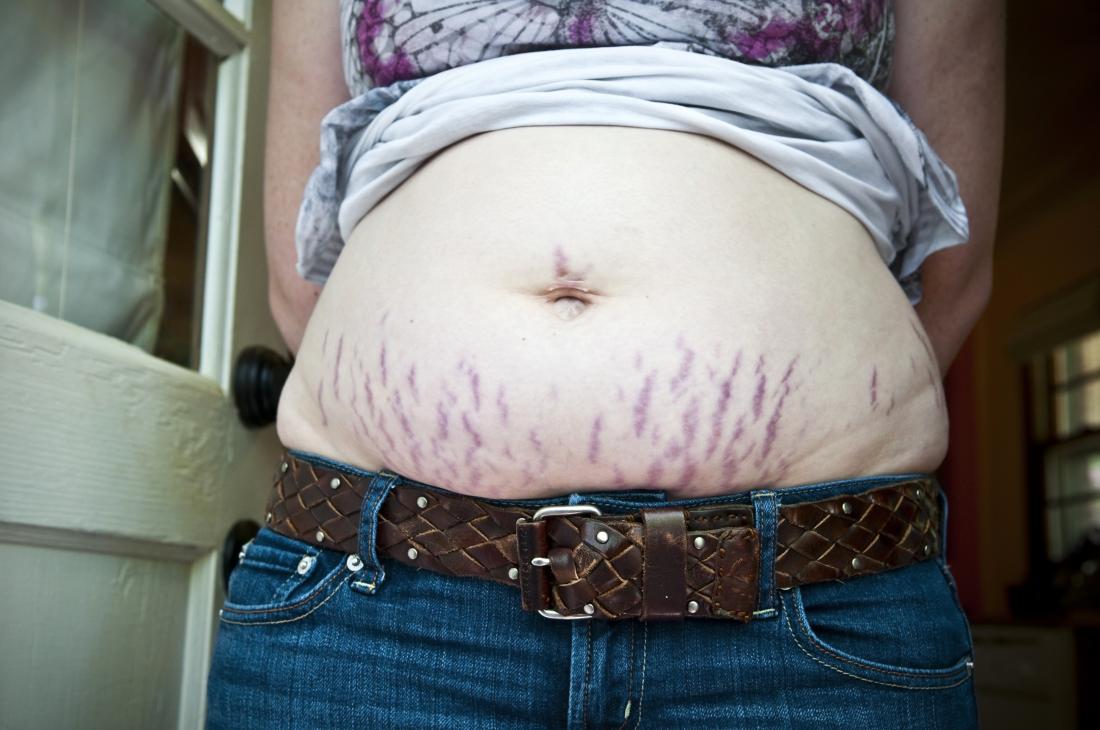 What are stretch marks and can you get rid of them? - Reviewed