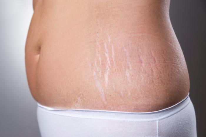 STRETCH MARKS REMOVAL - Dermatologicum