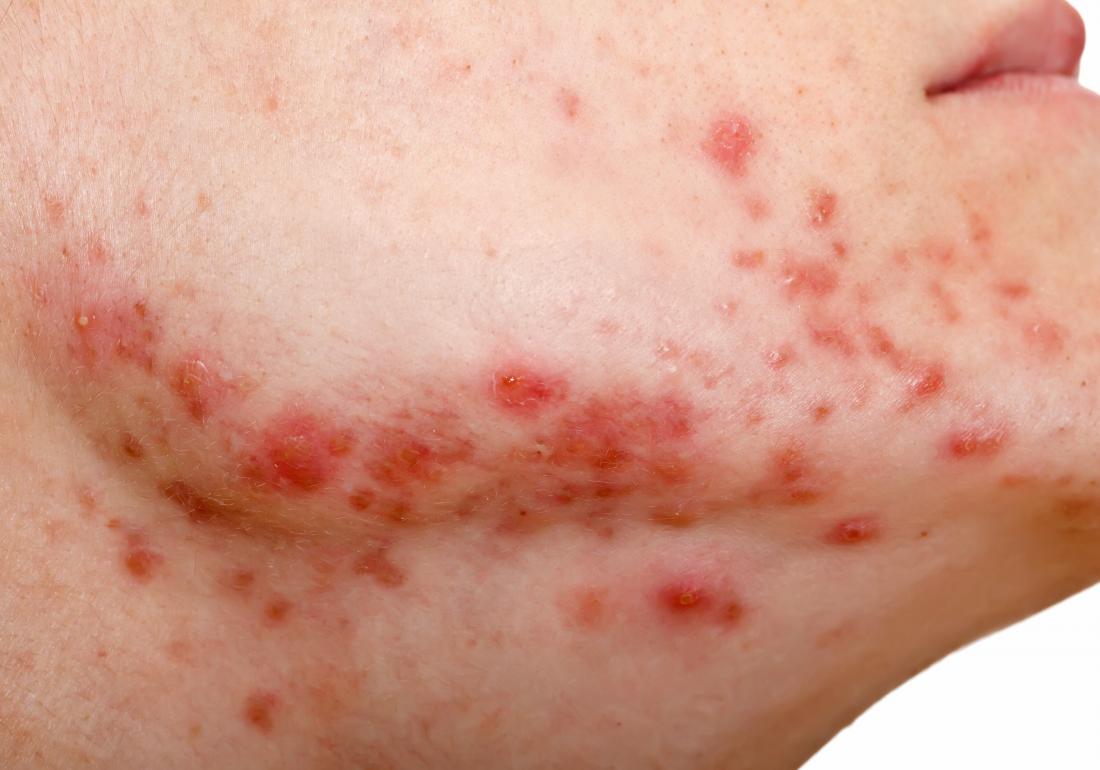 Acne severe body What Causes