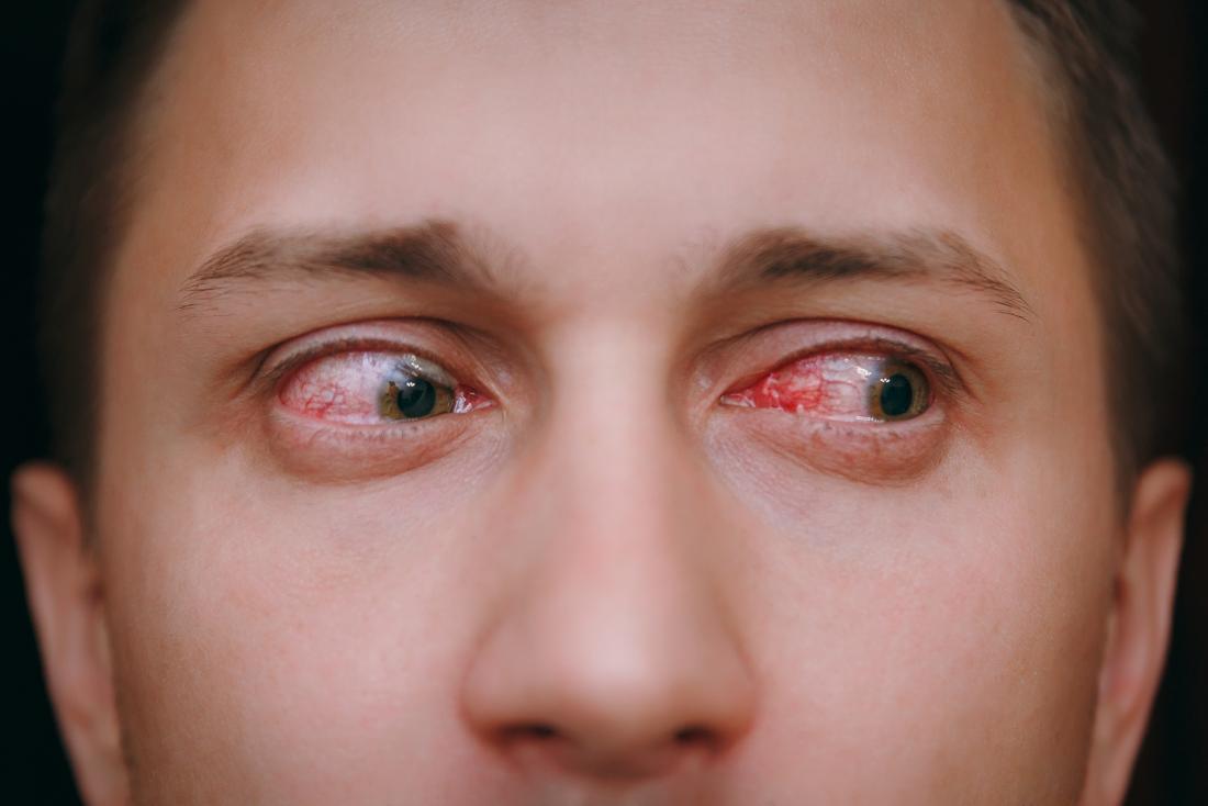 Red eyes: Home remedies and tips