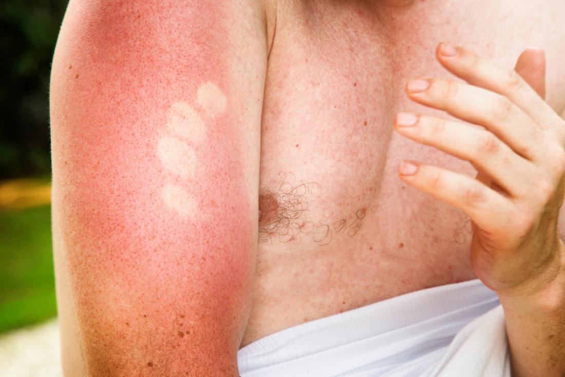 A man touching his sunburnt arm. Traumatic milia come from injury like burns or sometimes rashes.