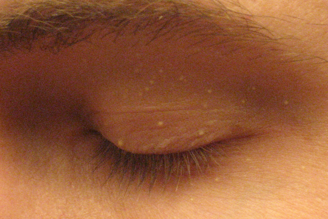 Milia on the eye, a common area for milia en plaque. <br>Image credit: Silver 442n, 2007</br>