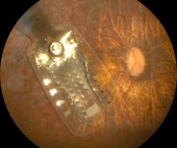 Fundus of the patient's eye implanted with Argus II Retinal 98 Prosthesis