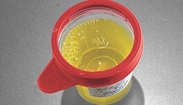 dark yellow urine symptoms