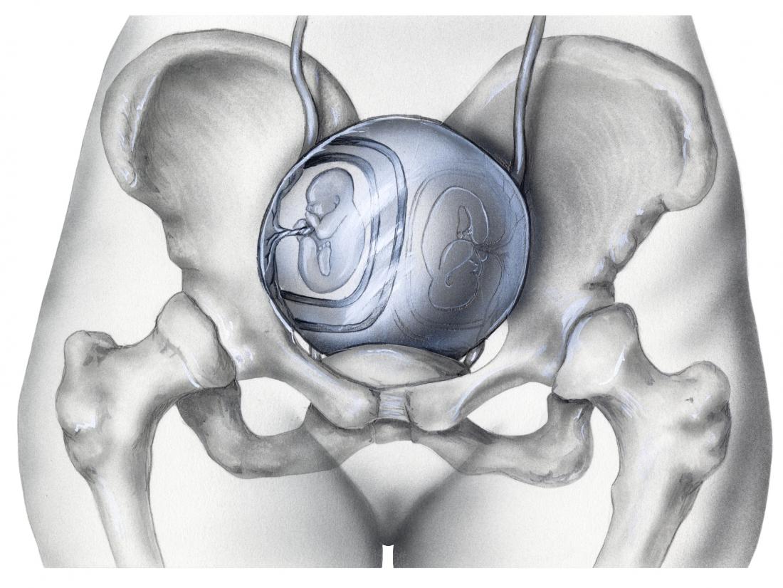 multiple gestational pregnancy
