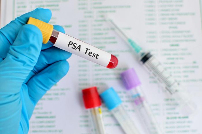 A labelled PSA blood test being held by a gloved hand