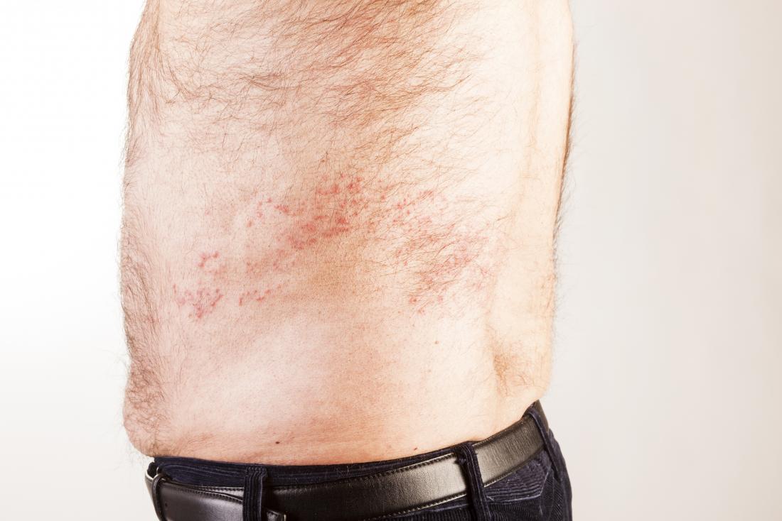 Is It Shingles Symptoms Vs Other Conditions And Causes