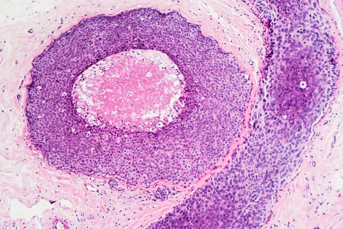 Stereotactic breast biopsy: What happens, results, and outlook