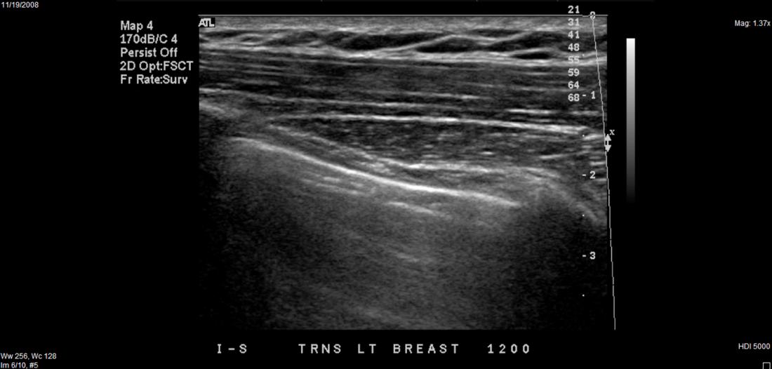 Diagnostic tests for a breast lump include ultrasound.