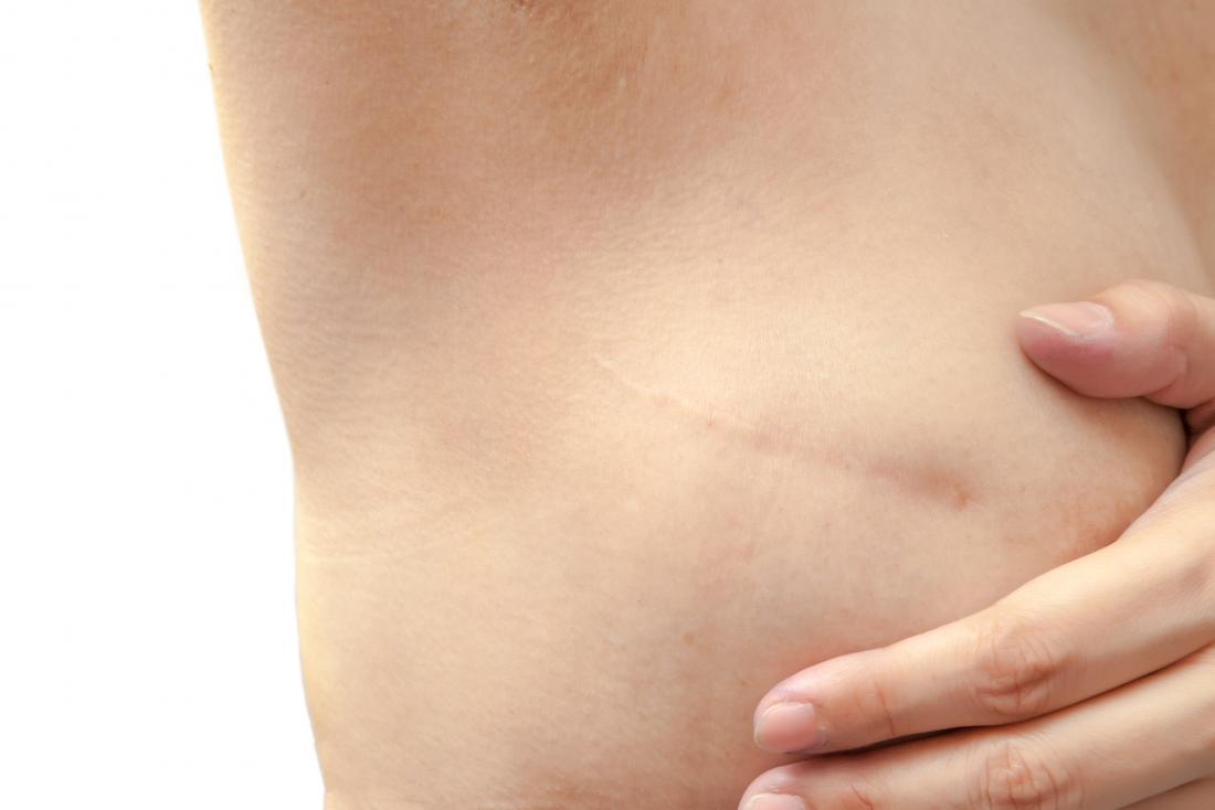 Surgery may be an outpatient or inpatient procedure. It may leave a small scar.
