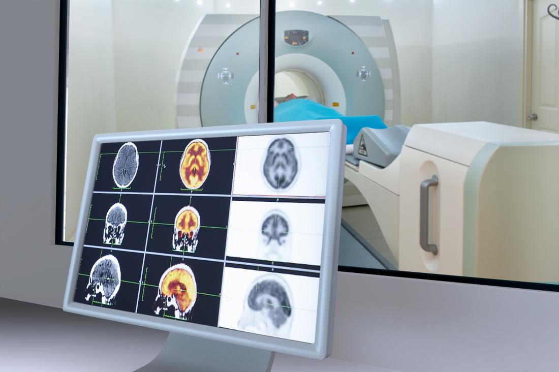 Stages Of Dementia Progression Treatment And Types