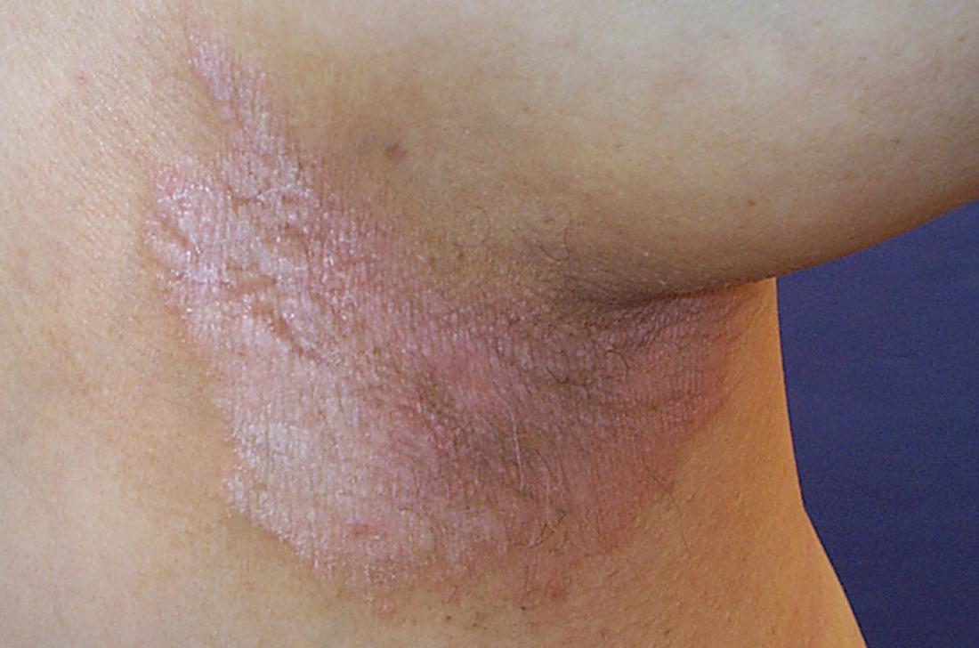 Inverse Psoriasis Causes Symptoms And When To See A Doctor 