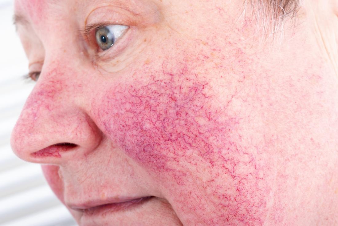 Acne Rosacea Vs Lupus Rash Lupus Misdiagnosis Diseases That Can Mimic
