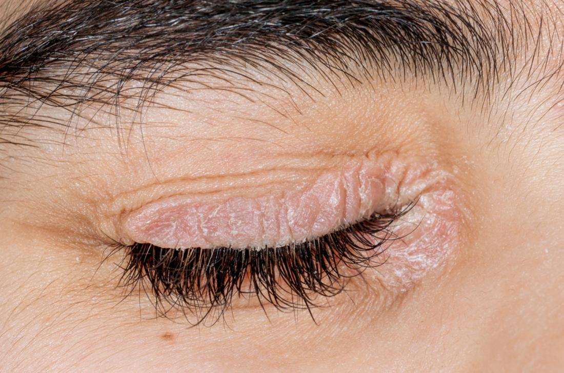 Psoriasis on the eyelids Symptoms, causes, and treatment