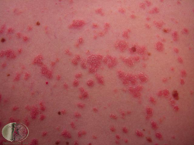 guttate psoriasis