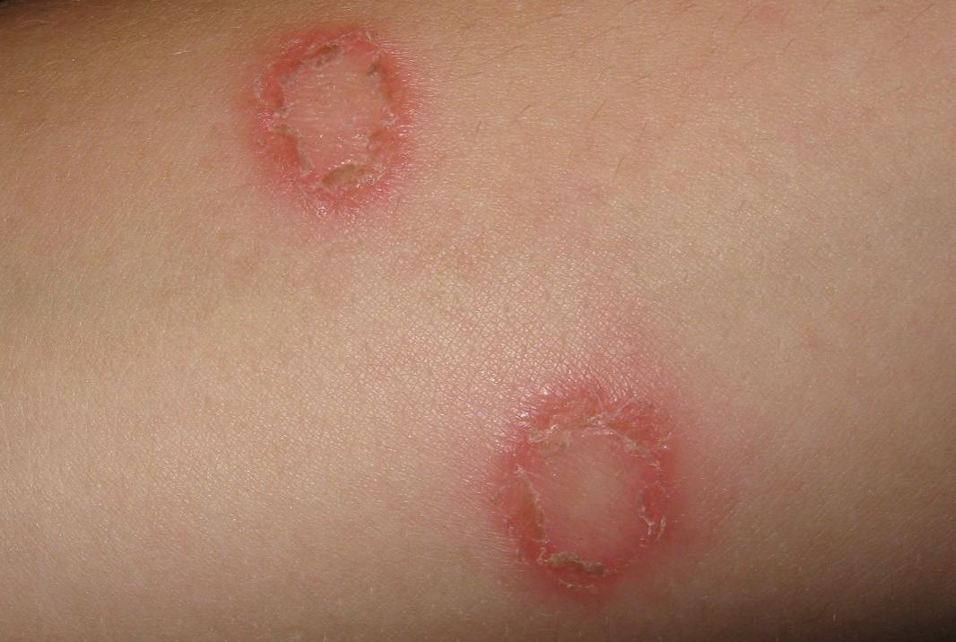 Psoriasis Rash Types Pictures And Symptoms