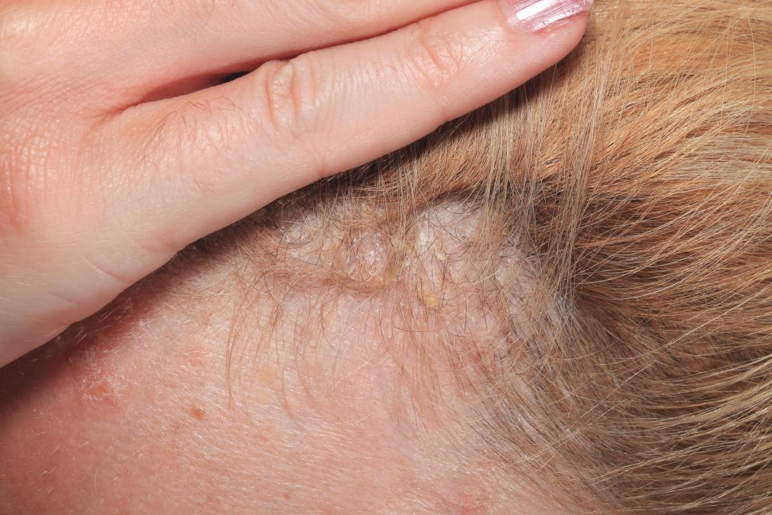 Scalp psoriasis