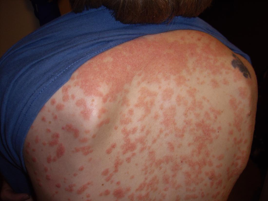 Guttate Psoriasis Causes Symptoms And Treatment