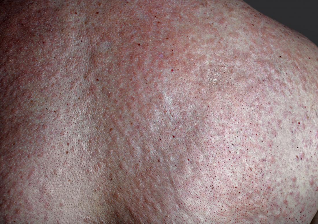 red skin may be pustular psoriasis