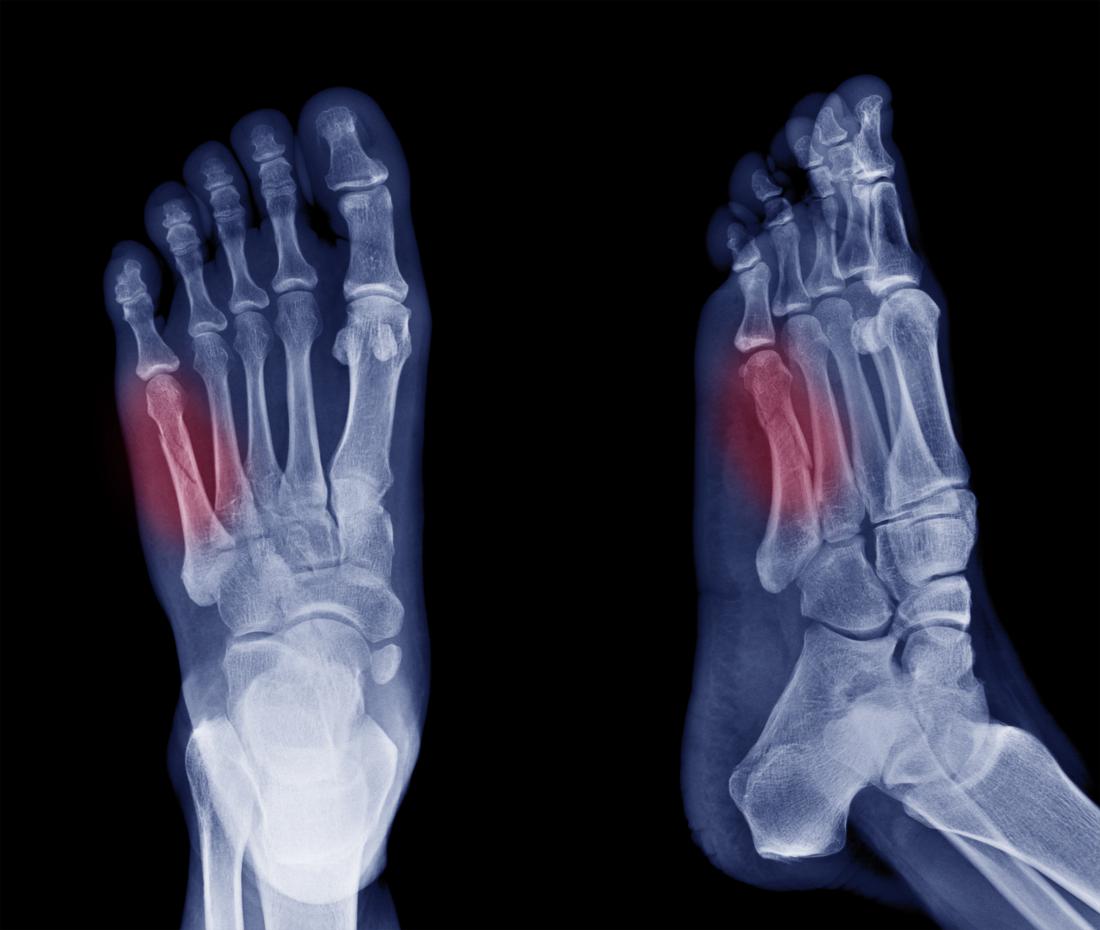 Jones fracture: Causes, symptoms, and 