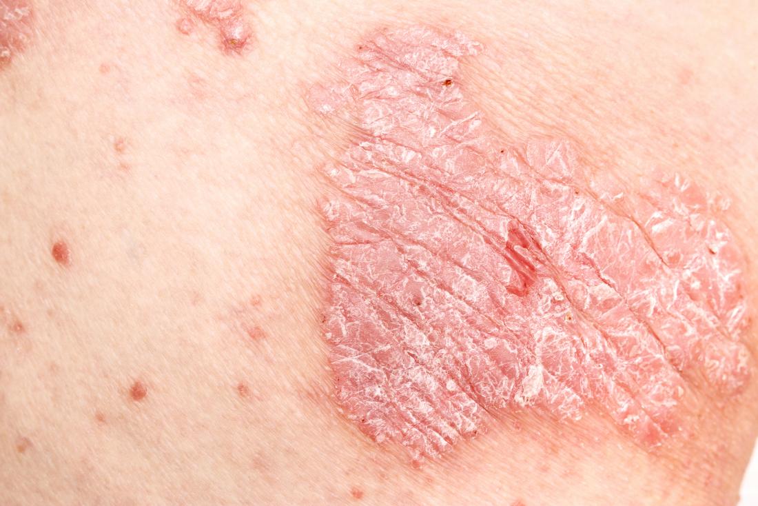 Genital psoriasis Symptoms, treatment, and causes