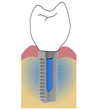 dental implant with reservoir