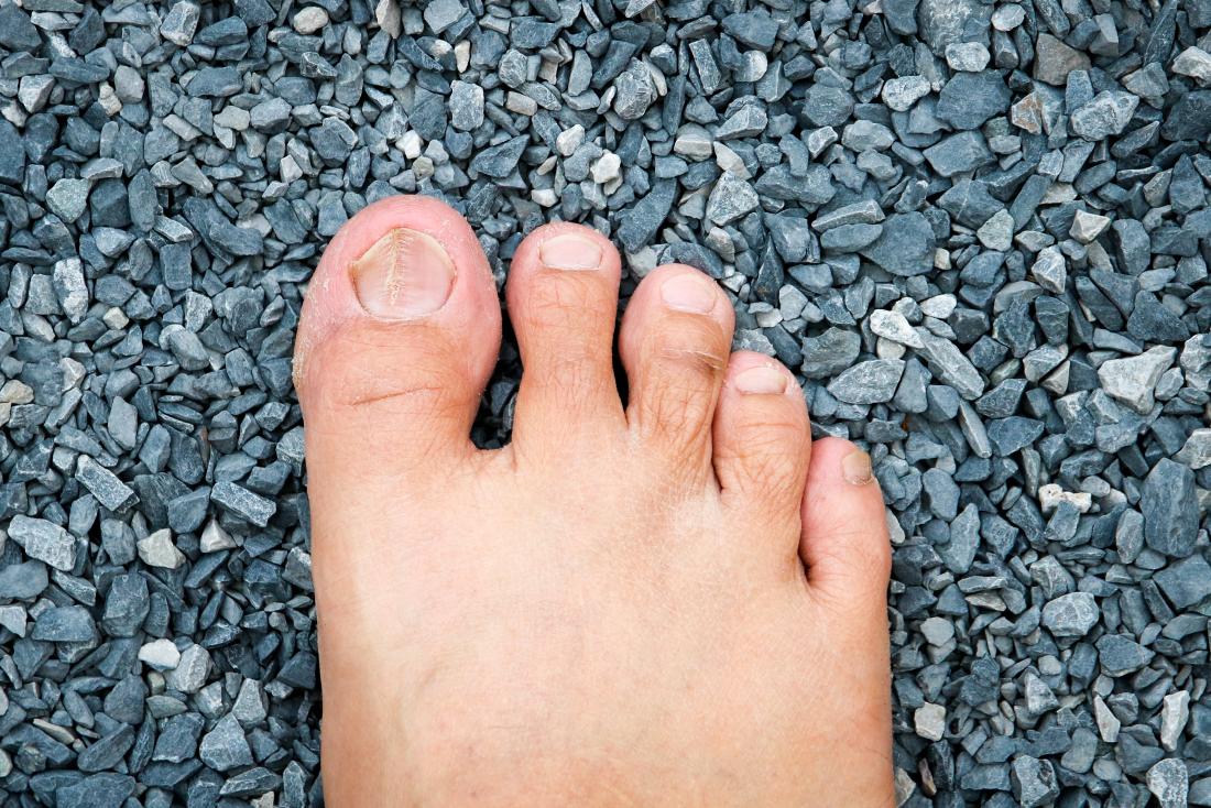 nail psoriasis
