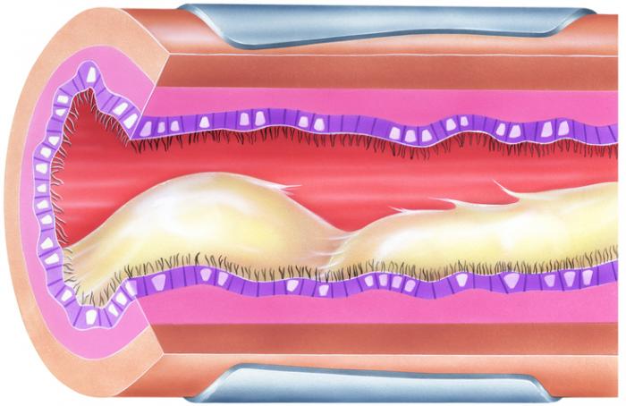 Bronchial Mucus Causing Airway Obstruction & Narrowing