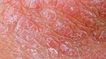 plaque psoriasis
