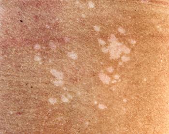 A man suffering from the skin condition Tinea Versicolor with