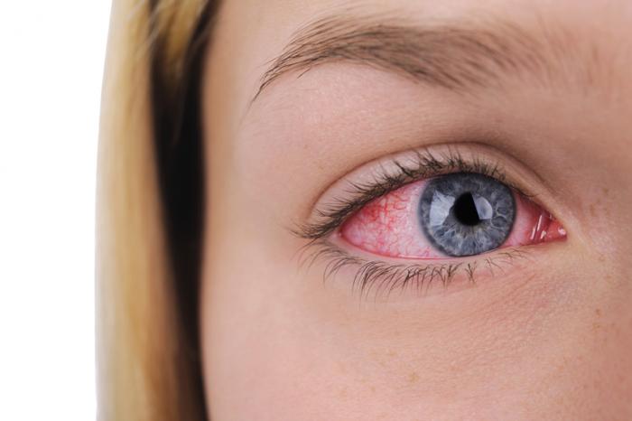 a ladies right eye that is bloodshot