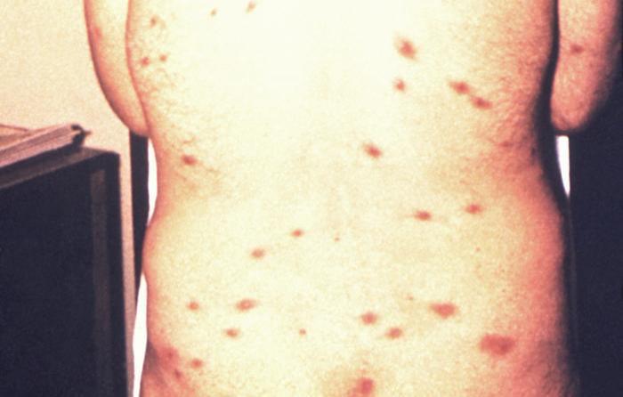 HIV rash Types, other symptoms, changes