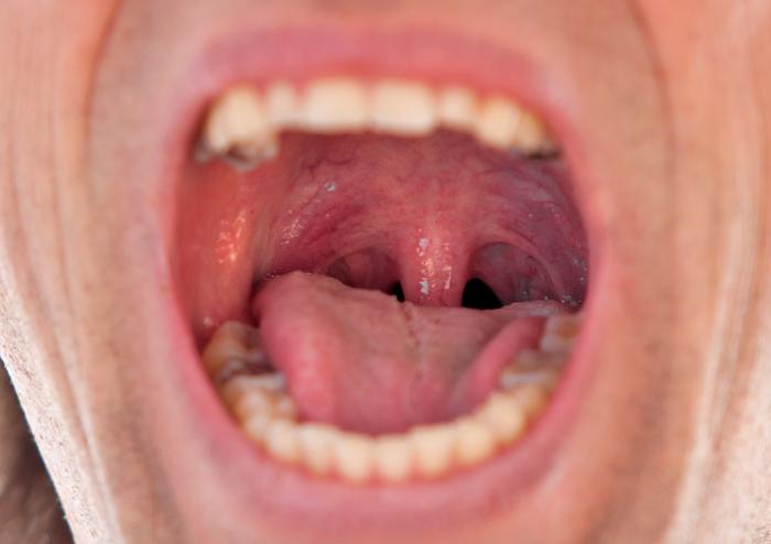 Allergy symptoms swollen tonsils