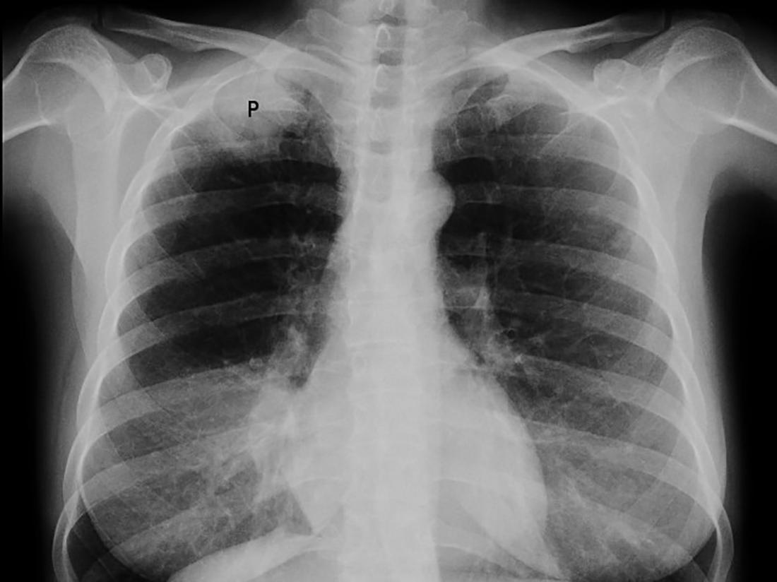 an x-ray of a Pancoast Tumor. Image credit: Jmarchn, 2010