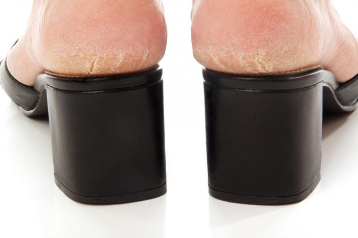 Tips to Take Care of Your Cracked Heels
