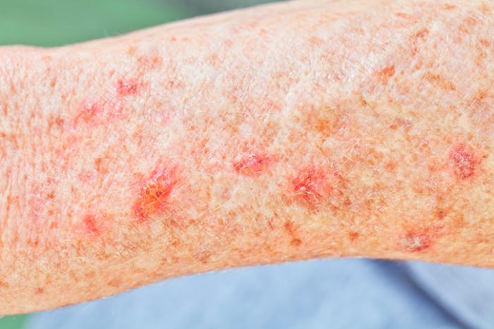 actinic keratosis