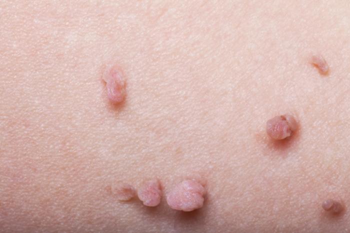 skin tag