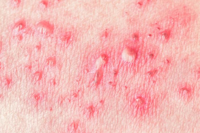 are genital skin tags herpes