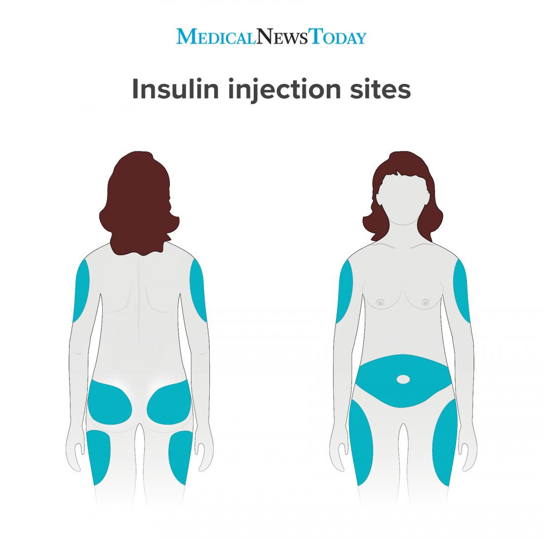 insulin injection sites infographic